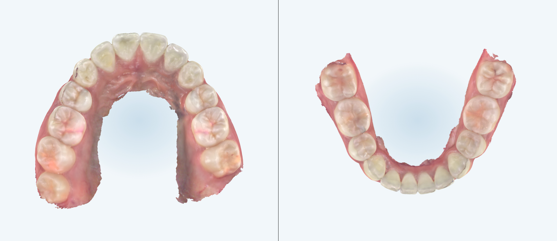 Crowding treatment comparison case 3 after